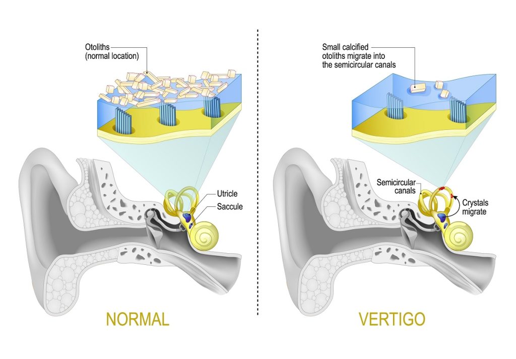 Benign paroxysmal positional vertigo. BPPV