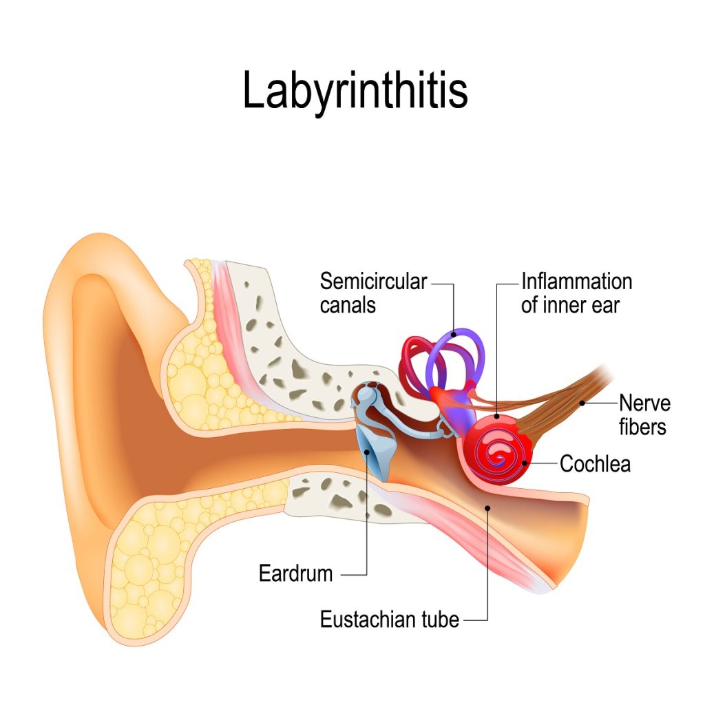 Labyrinthitis