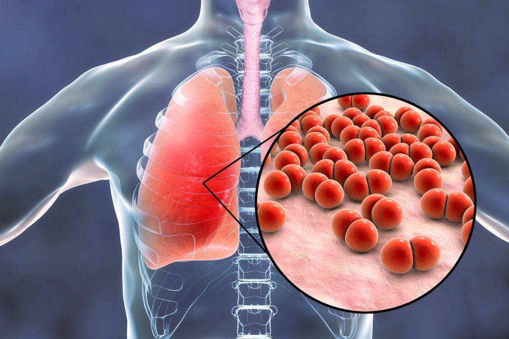 Pneumococcal pneumonia