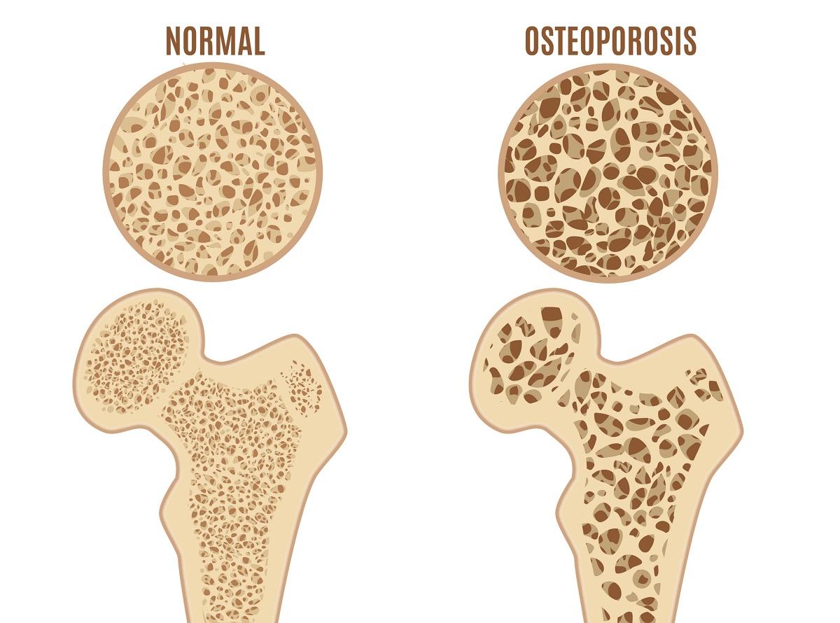 Osterporois