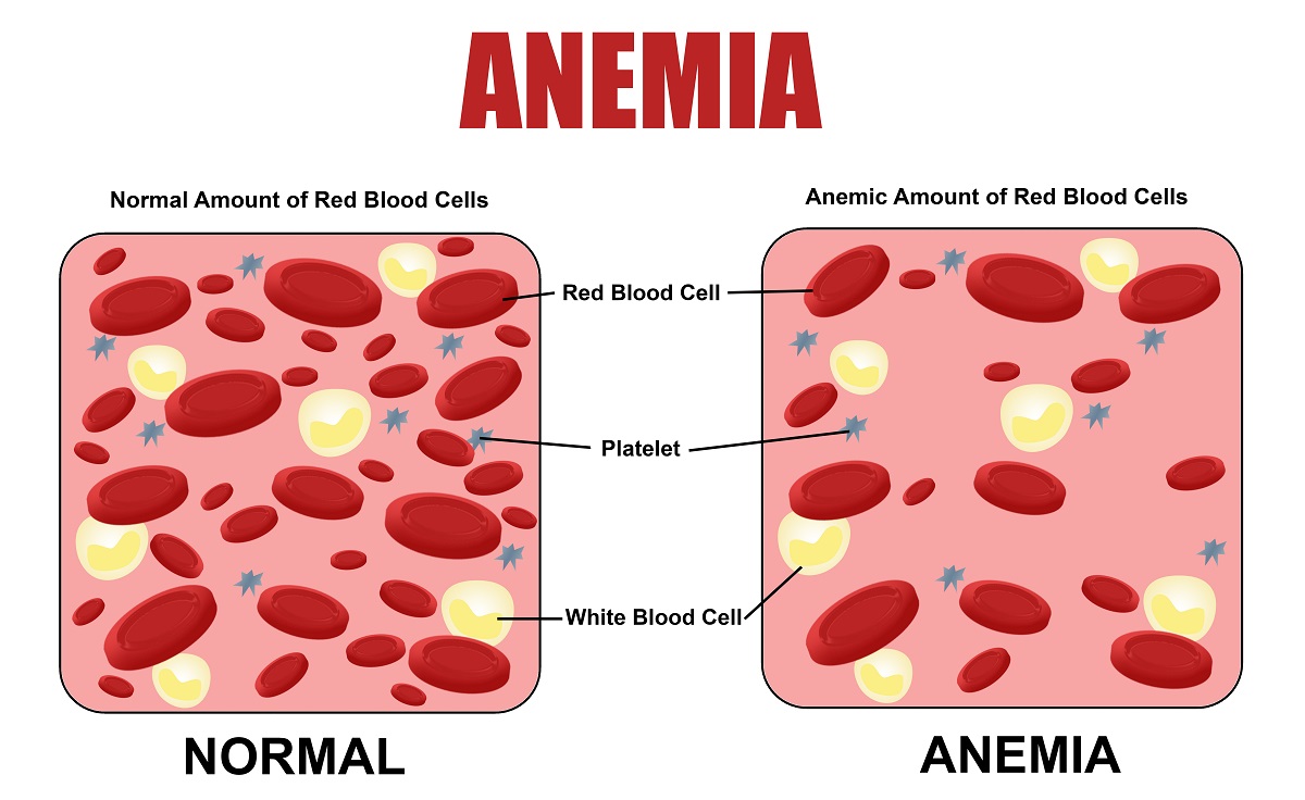 Do you have memory loss anemia