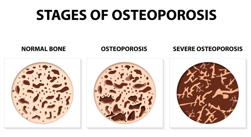 Stage of osteroporosis